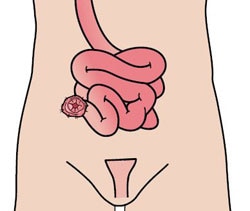 Ileostomy Ileostomy
