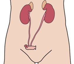 Urostomy Urostomy