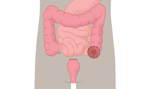 Sigmoideostomie