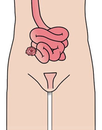 Co je koncová ileostomie?