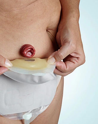 Je výměna nebo vypouštění urostomického sáčku obtížná?