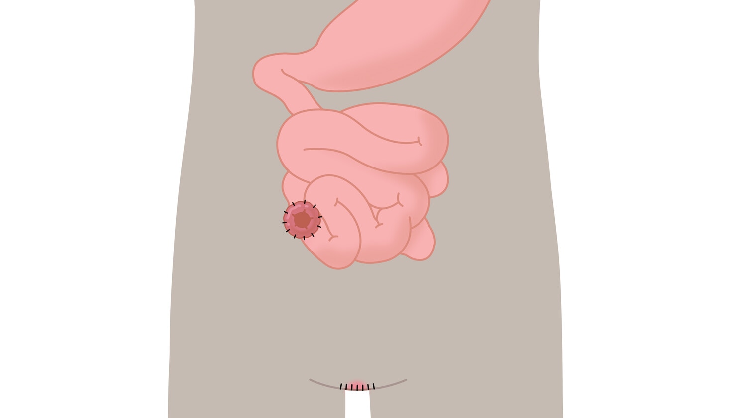 Terminální ileostomie a amputace rekta