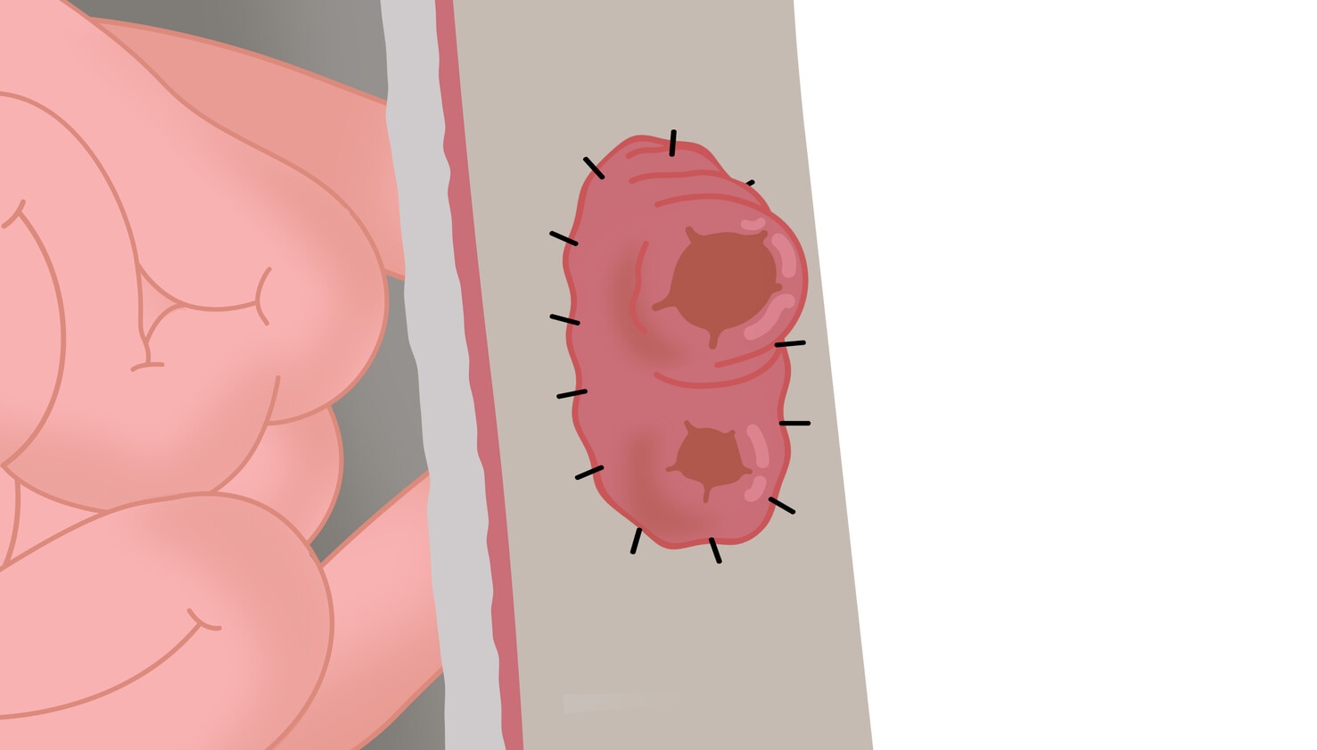 Dvouhlavňová ileostomie - detail