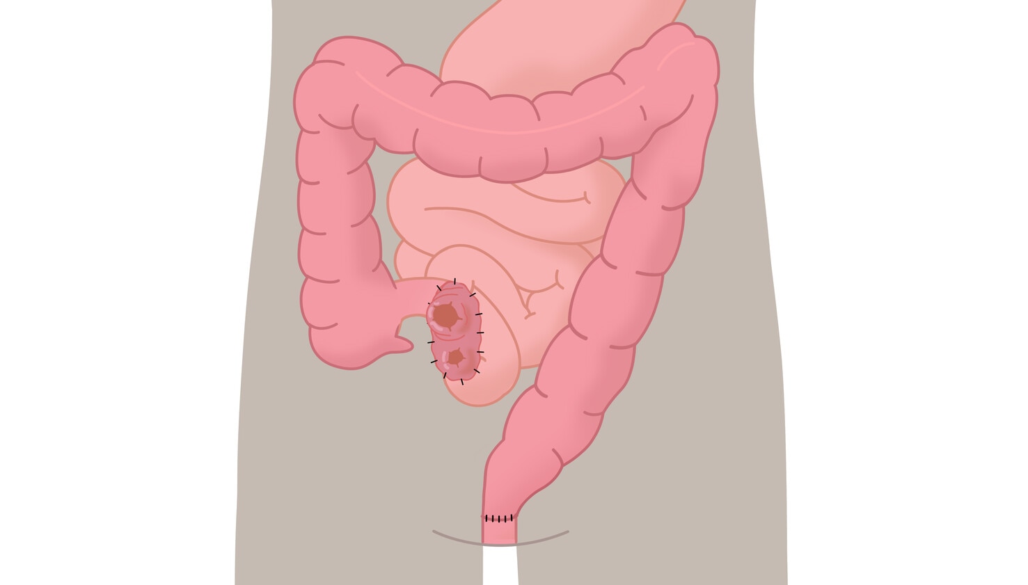 Dvouhlavňová ileostomie