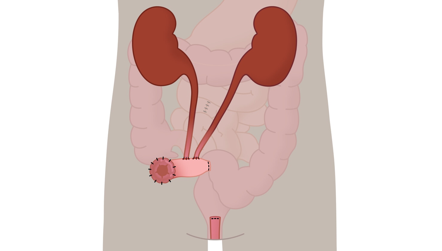 Urostomie - ureteroileostomie