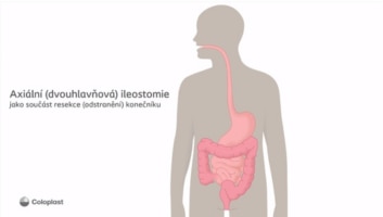 Axiální ileostomie jako součást resekce konečníku