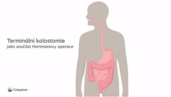 Terminální kolostomie jako součást Hartmanovy operace