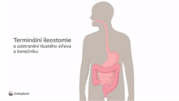 Terminální ileostomie a odstranění tlustého střeva a konečníku