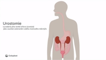 Urostomie vyvedená přes tenké střevo (conduit) jako součást odstranění močového měchýře